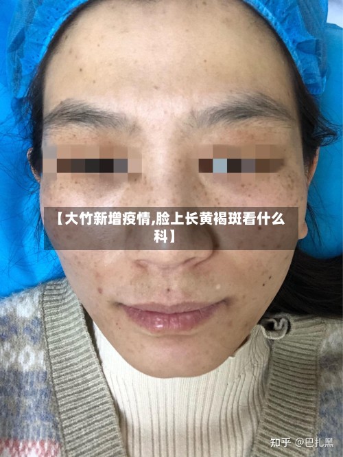 【大竹新增疫情,脸上长黄褐斑看什么科】-第3张图片